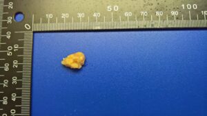 胰腺癌细胞系A25原位成瘤